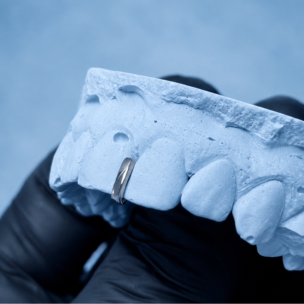 A close-up of a dental lab model showing a row of teeth with a silver metal band, held by a hand in a black glove against a textured blue background.