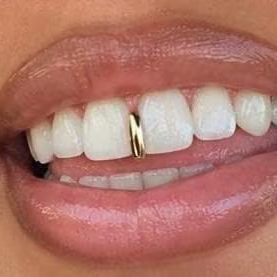 Gap Filler Grillz Cap! Gold, Silver!